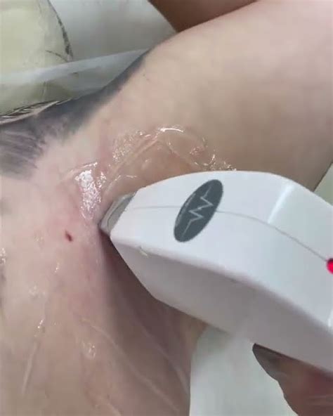 RazorLase️ diode laser hair machine диодный лазер для удаления волос ...