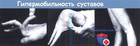 Симптомы гипермобильности суставов и ее лечение