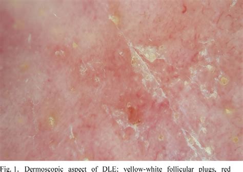 Figure 1 from Utility of polarized dermoscopy in the diagnosis of ...