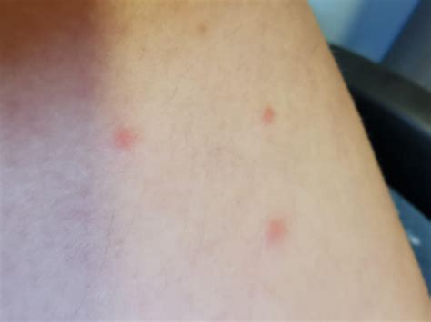 Are this bed bugs bites?? : r/DermatologyQuestions