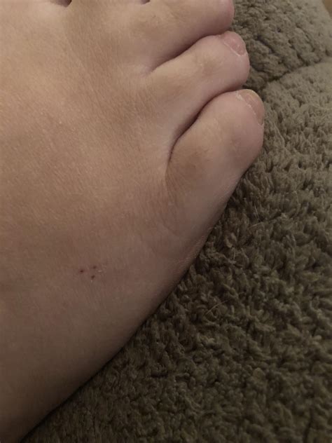 I was trying to AP and the next morning I woke up with this mark on my