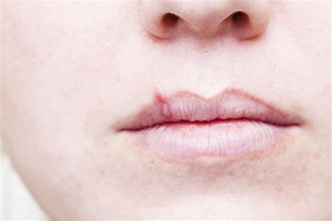 Herpes: Signs, Symptoms and Complications