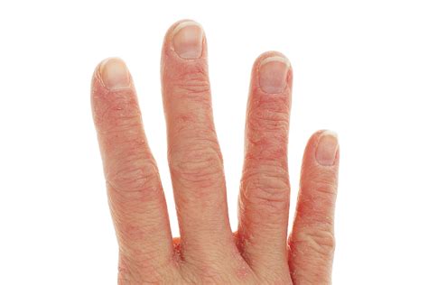 Chronic Hand Dermatitis: A Practical Guideline for General Practitioner