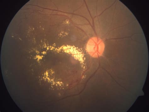 Clinically Significant Macular Edema