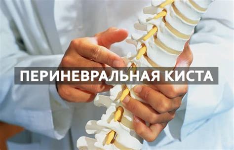 Периневральная киста: что это такое, симптомы, диагностика, лечение