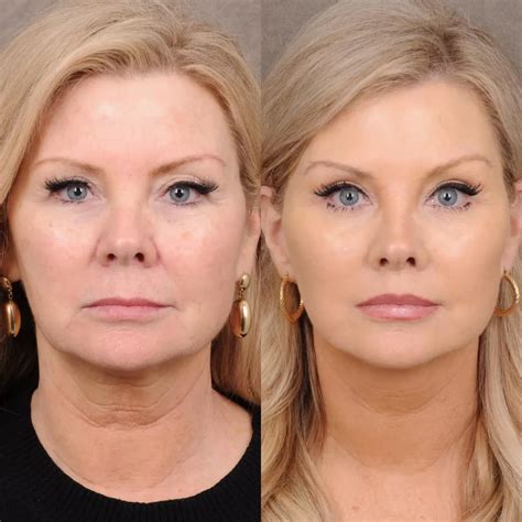 facelift      journey