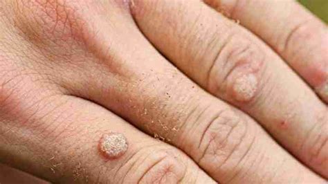 Skin Cancer or Benign Wart - How To Identify Cancerous Warts