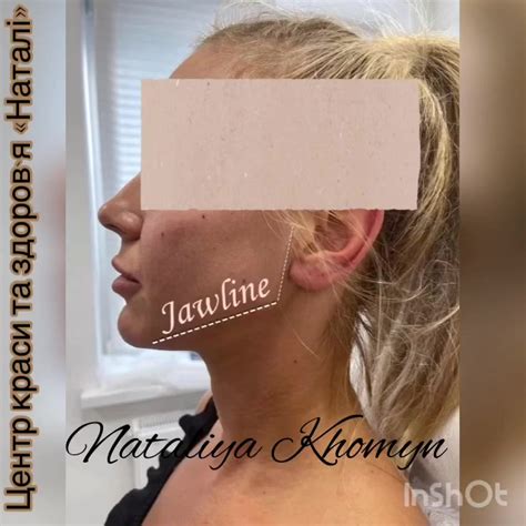 💉«Кути Джолі» – новітня ін’єкційна методика ,шляхом якої в область ...