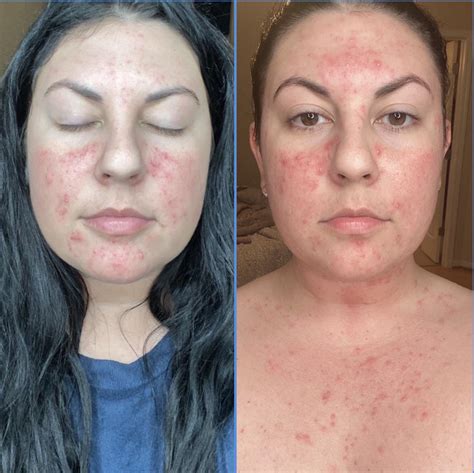 Super hard to post but wanted to share my progress since August! Type 2 ...