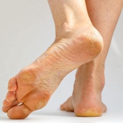 callus podiatrist  orlando fl timothy mason dpm