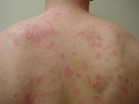 5 Things To Know About Pityriasis Rosea Pityriasis Ro - vrogue.co