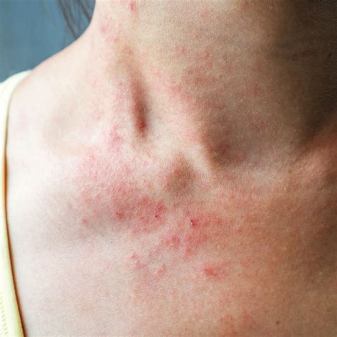 Rashes — Virginia Square Dermatology - Isabela Jones, MD