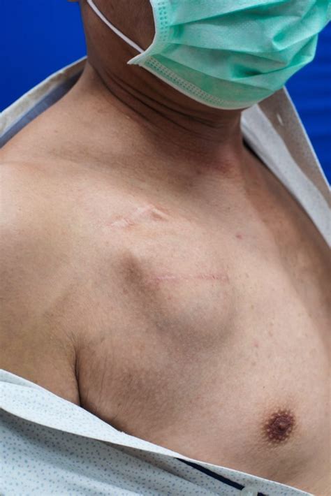 implanting  pacemaker  rhythm device