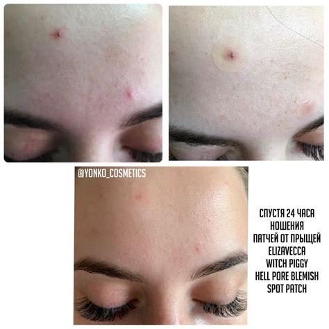Локальные средства от прыщей - Witch Piggy Hell Pore Blemish Spot Patch ...