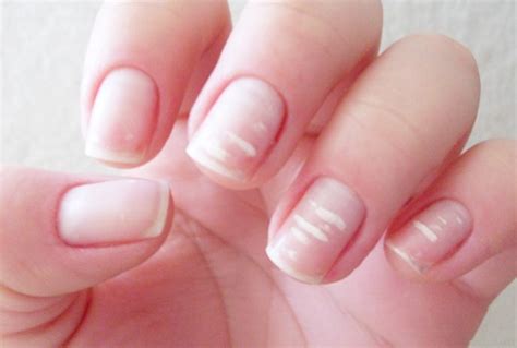 Unhas Esbranquiçadas O Que Pode Ser - Como resolver: Unhas esbranquiçadas - Dra. Luciana Pepino