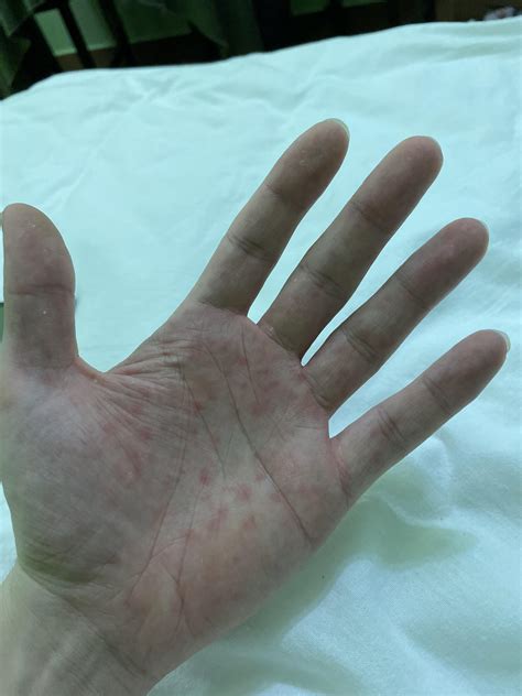 What are those spots? They don’t hurt during the day, just in the ...