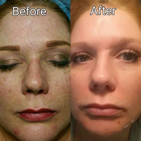 how to remove the freckles 2