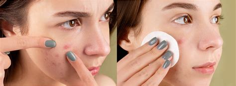 skin anti acne creative bioarray