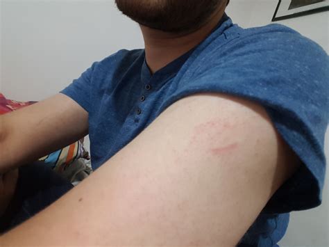 Pain and redness in upper left arm : r/AskDocs