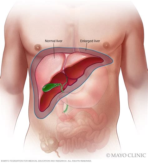 Enlarged liver - Symptoms & causes - Mayo Clinic