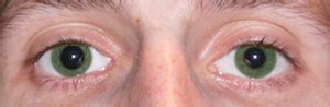 Anisocoria: Definition, Causes & Symptoms | Study.com