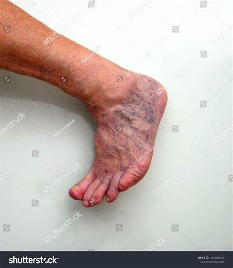 Skin Discolouration Images: Browse 245 Stock Photos & Vectors Free Download with Trial ...