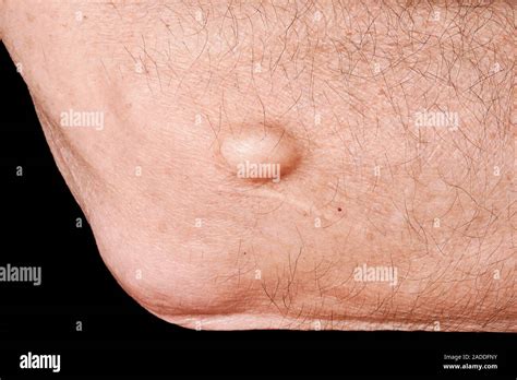 cyst   elbow    linda france blog