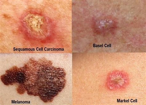 skin cancer types symptoms   prevention vrogueco