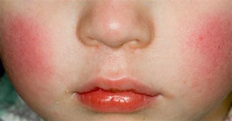 Virus Parvo có lây sang người không? | Vinmec
