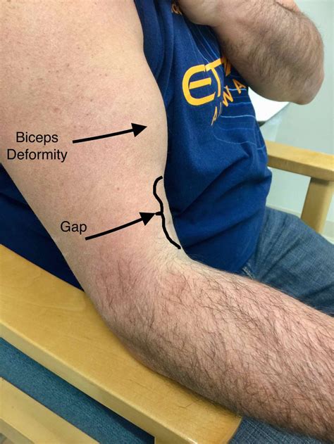 Does A Bicep Tear Require Surgery? – Howard J. Luks, MD