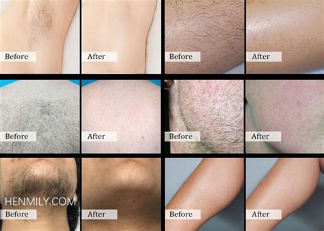 Laser Hair Removal Before and After: Say Goodbye to Unwanted Hair ...