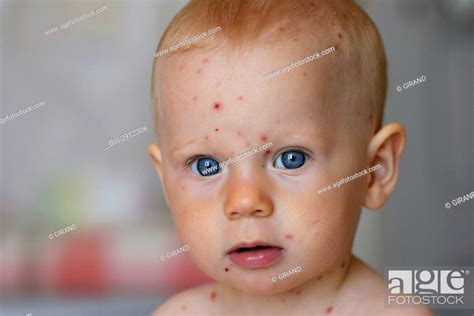 Chickenpox on a 1-year-old child 5th day, Stock Photo, Picture And ...
