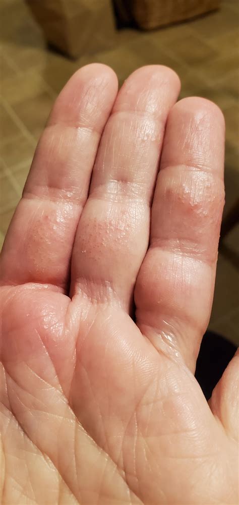 Possible nickel allergy? : r/Dyshidrosis