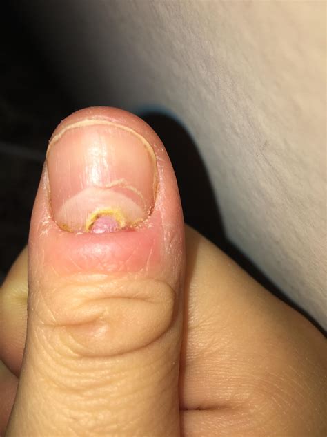 Why does my right thumb look like that? : r/DiagnoseMe
