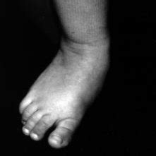 surgical rehabilitation   planovalgus foot  cerebral palsy