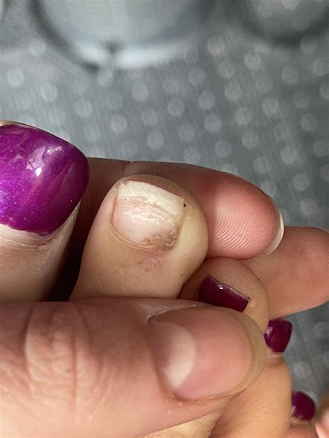 Dark Spot Under Nail : r/DermatologyQuestions