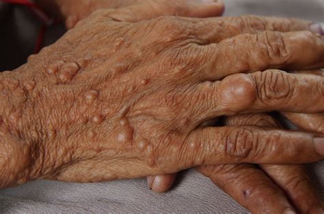 Neurofibromatosis - Types, Causes, Prevention & Treatment Only At blog ...