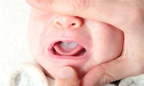 Como E Sapinho No Bebe - Sapinho no bebê – Como tratar! – Gravidez e Filhos