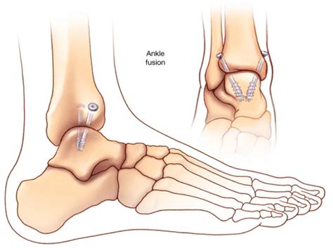 Ankle Surgery may be an option more-conservative treatments