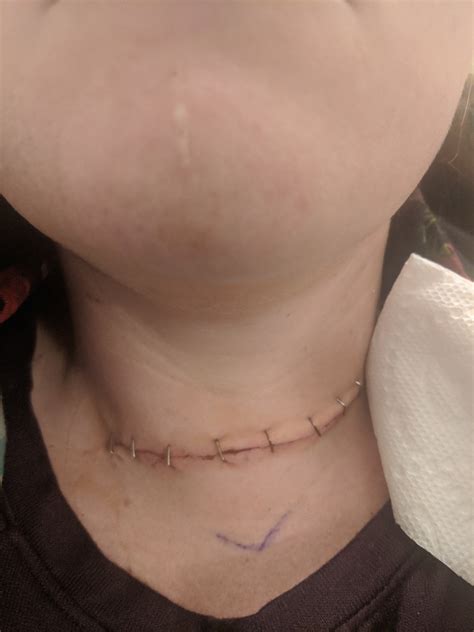 What Doctors Won't Tell You About The Hisashi Ouchi Tragedy: The Shocking Story Behind The Images Image 17