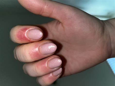 Allergic Reactions Linked to Artificial Nails - Women Fitness