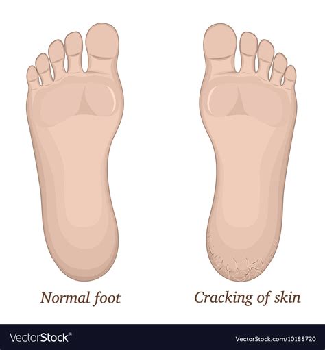 cracks   skin   foot royalty  vector image
