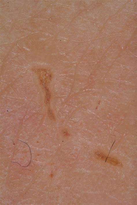 Larva migrans, dermatoscopia - DocCheck