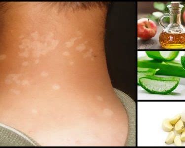 Natural Herbal Remedies for Tinea Versicolor Treatment - Herbal Care ...