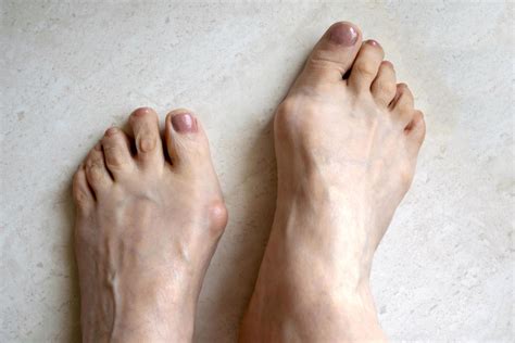 Bunion Treatment in Omaha, NE | Mid Plains Podiatry