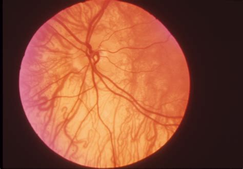 Oculocutaneous Albinism Symptoms