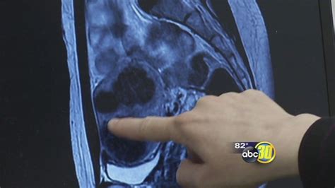 New treatment options shrink fibroids without major surgery - ABC30 Fresno