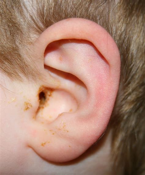 Ear Infection After Tubes Put In at Karen Ruhl blog