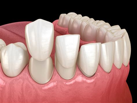 replacing missing teeth replace multiple missing teeth