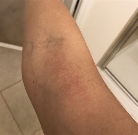 Pain in my right arm after IV. Should I be concerned? : r/medical_advice